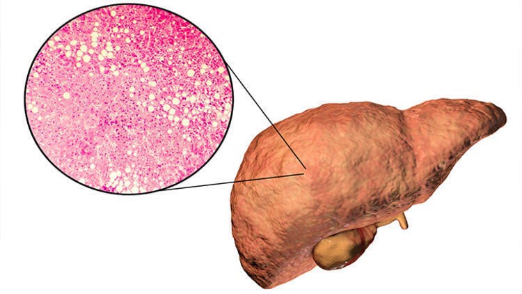 Karaciğer kanserinden korunmak için yapılması gereken 5 şey