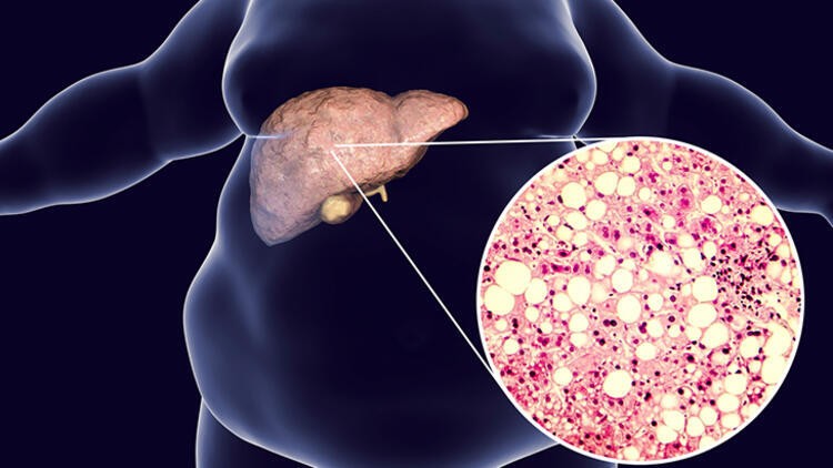 Karaciğer kanserinden korunmak için yapılması gereken 5 şey