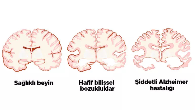 Milyonlarca kişiyi ilgilendiriyor: Aşı Alzheimer'a umut olur mu?