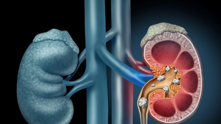 Yerken bir kez daha düşünün: Böbrek taşına neden oluyor!