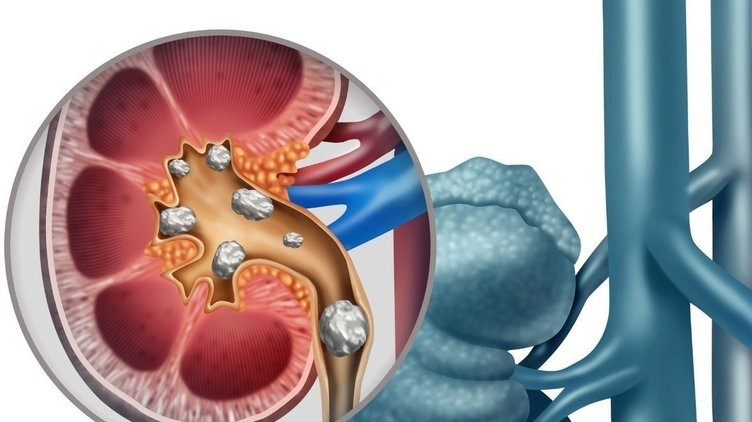 Yerken bir kez daha düşünün: Böbrek taşına neden oluyor!