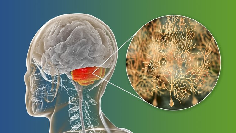 İşte Alzheimer'ı 6 yıl önceden haber veren belirti!