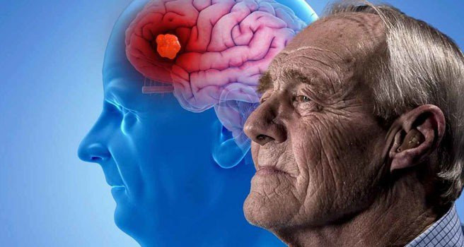 İlk adımlar atıldı: Alzheimer'ı yok edecek!