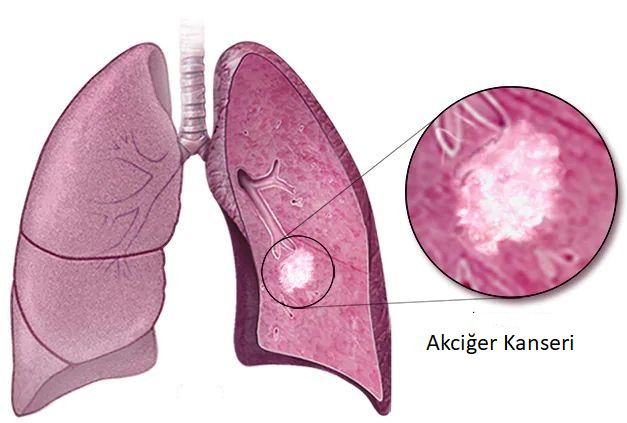 Dikkat! O bulgular akciğer kanseri belirtisi olabilir