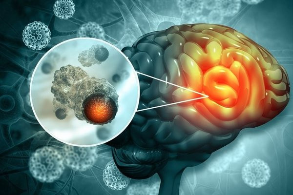 30'lu yaşlara dikkat: Alzheimer'ın en büyük sebebi...