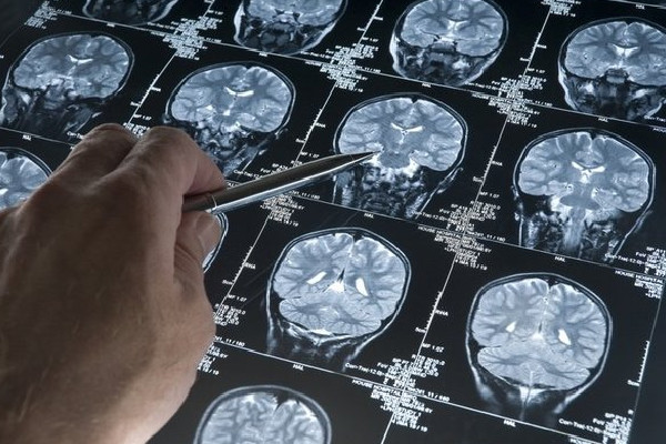 30'lu yaşlara dikkat: Alzheimer'ın en büyük sebebi...