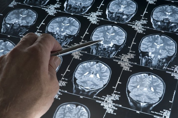 Alzheimer'ın ilk işareti tuvalette ortaya çıkabilir: Şaşırtıcı semptom!