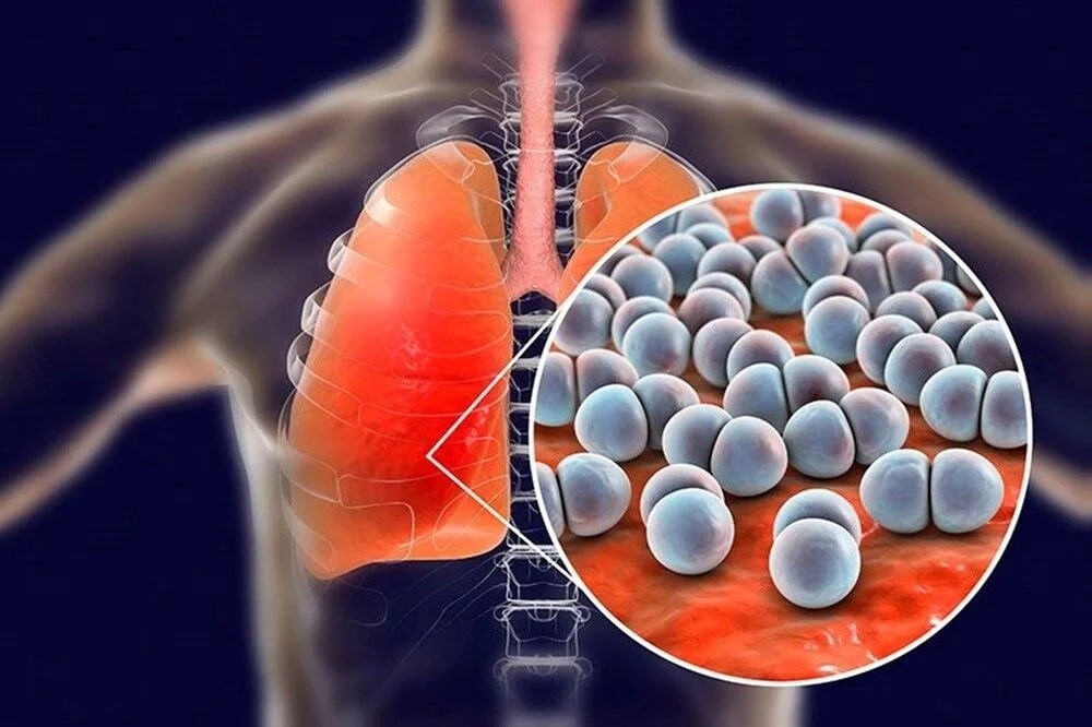 Strep A kabusu büyüyor: Korkutan uyarı!