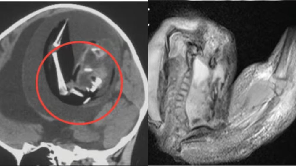 1 yaşındaki kız çocuğunun beyninden fetüs çıkarıldı!