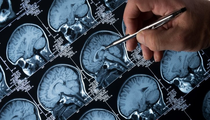 Alzheimer 20 yıl önce bu belirtiyle sinyal veriyor: Bu besin riski sıfırlıyor!