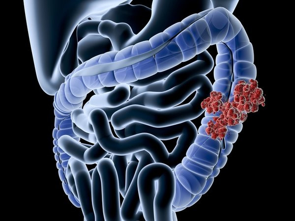 Kanserin ana sebebiymiş: Doktorların önemle vurguladığı 5 madde!