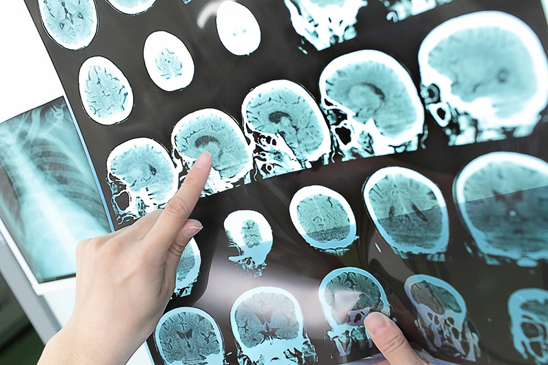 Alzheimer'ın ilk belirtisi olabilir: Özellikle fıstık ezmesi testine dikkat!